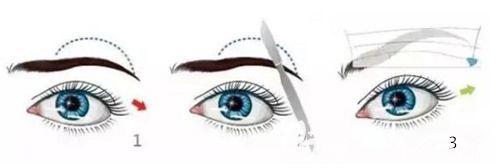直接提眉術(shù)手術(shù)步驟簡(jiǎn)易圖