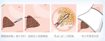 腹部吸脂手術(shù)過程示意過程