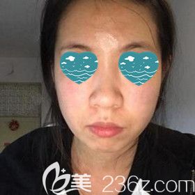 做假體墊下巴術(shù)前照 做假體墊下巴術(shù)前照