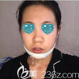 假體墊下巴術(shù)后1天照 假體墊下巴術(shù)后1天照