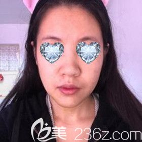 做假體墊下巴術(shù)后9天照 做假體墊下巴術(shù)后9天照