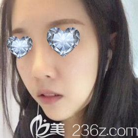 在沈陽(yáng)元辰做假體墊下巴術(shù)后15天效果圖 在沈陽(yáng)元辰做假體墊下巴術(shù)后15天效果圖