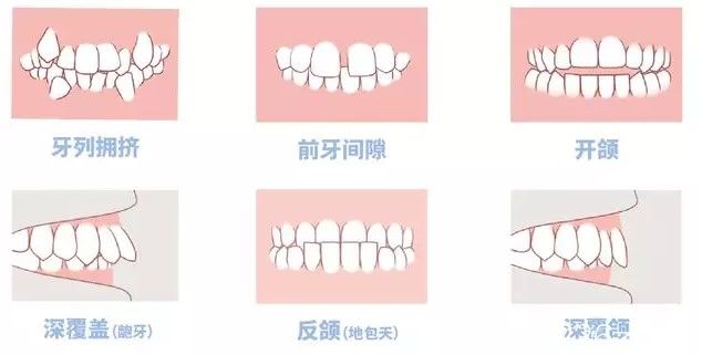 孔明星醫(yī)生科普：什么時候給孩子矯正牙齒好呢