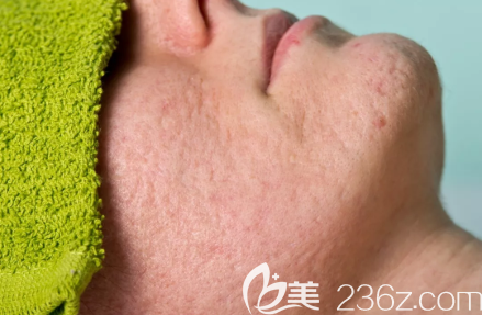 縮小毛孔改善粗糙