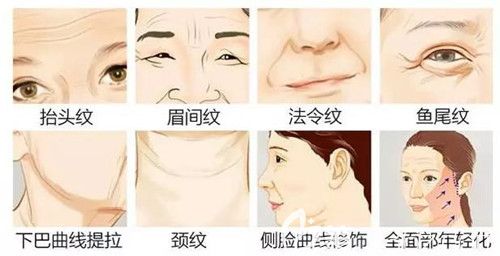 埋線提升去除川字紋