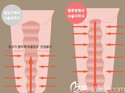 韓國好手藝好手藝后方膣圓蓋手術(shù)