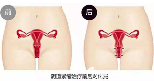 韓國好手藝好手藝陰道緊縮術(shù)效果