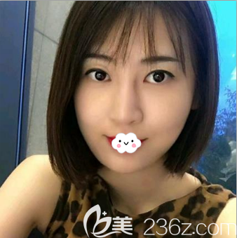 埋線提升術(shù)前正臉照 埋線提升術(shù)前正臉照