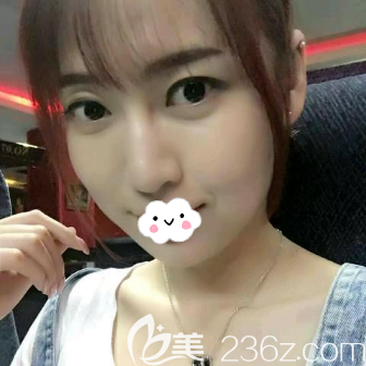 埋線提升術(shù)前側(cè)臉照片 埋線提升術(shù)前側(cè)臉照片