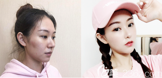 廣州曙光程鵬醫(yī)生隆鼻和脂肪填充