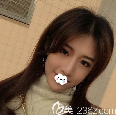 內(nèi)江達(dá)芬奇鄧子力給我做駝峰鼻矯正的時候用耳軟骨墊鼻尖，術(shù)后可以揉捏超級自然