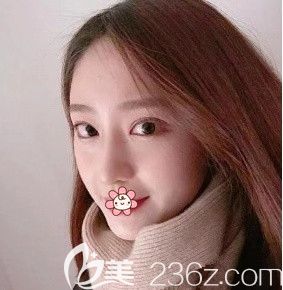 韋小勇鼻綜合術(shù)后84天 韋小勇鼻綜合術(shù)后84天