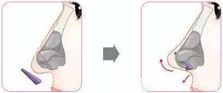 鷹鉤鼻矯正方法