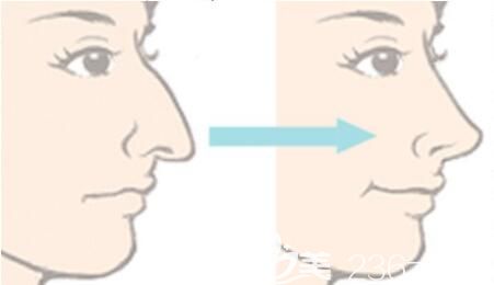 鷹鉤鼻矯正后遺癥