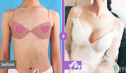 北京美萊董巖巖假體隆胸案例 北京美萊董巖巖假體隆胸案例