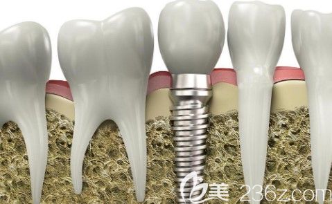 李金林種植牙技術(shù)特點(diǎn) 李金林種植牙技術(shù)特點(diǎn)