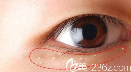 眼周脂肪粒