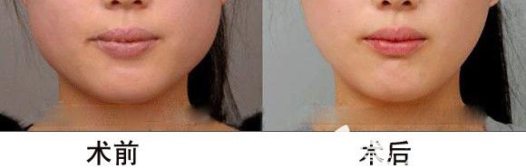 閨蜜做去頰脂墊術(shù)前術(shù)后對比效果 閨蜜做去頰脂墊術(shù)前術(shù)后對比效果