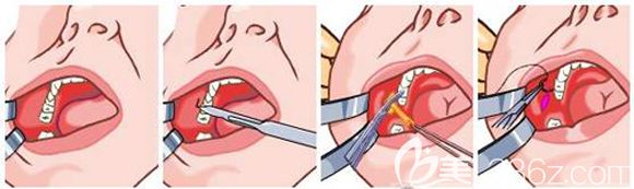 去頰脂墊手術(shù)步驟簡易圖 去頰脂墊手術(shù)步驟簡易圖