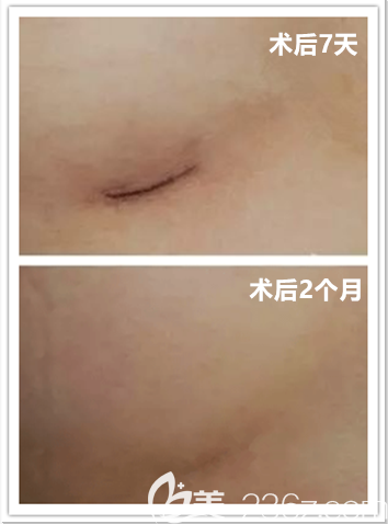 疤痕幾乎看不出
