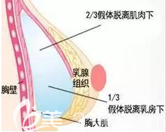 乳房假體的位置