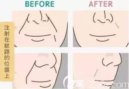 玻尿酸填充法令紋