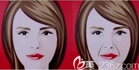 玻尿酸填充法令紋后表情會僵硬嗎？