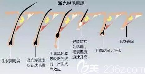 激光脫毛整形過程