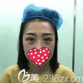 在名流做雙眼皮修復(fù)術(shù)后即刻效果照片 在名流做雙眼皮修復(fù)術(shù)后即刻效果照片