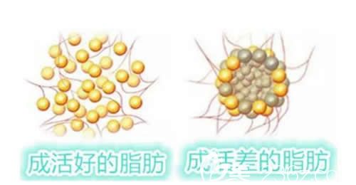 脂肪填充后熱敷不利于脂肪細(xì)胞成活