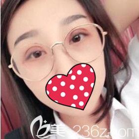 在沈陽名流修復(fù)雙眼皮術(shù)后20天效果照 在沈陽名流修復(fù)雙眼皮術(shù)后20天效果照