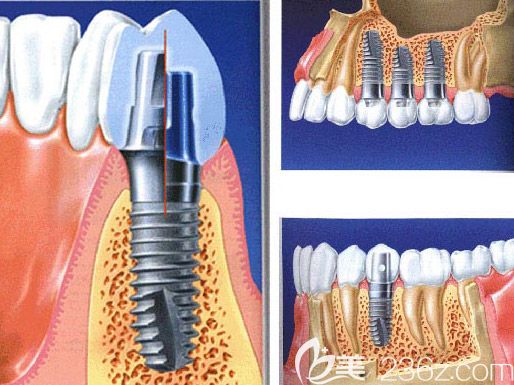 北京維嘉口腔任毅醫(yī)生介紹微創(chuàng)種植牙技術(shù) 北京維嘉口腔任毅醫(yī)生介紹微創(chuàng)種植牙技術(shù)
