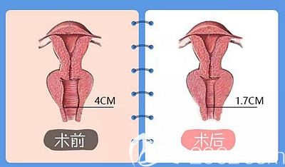 洛陽華美陰道緊縮手術原理