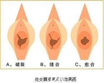 洛陽華美處女膜修復手術原理
