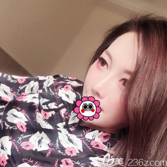 預(yù)約了比較有名氣的寧波靜港林忠泵為我做的綜合鼻整形一個月恢復(fù)滿意效果