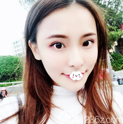 廣州曙光張小蕓做玻尿酸填充怎么樣