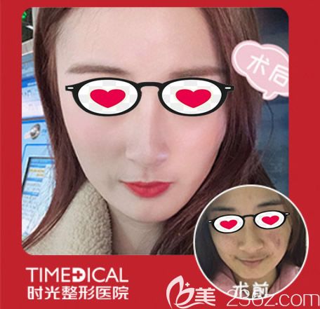 蘭州時光皮秒激光祛斑10天