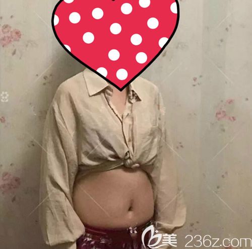 我找贛州薇琳鐘林輝做腰腹環(huán)吸術(shù)前 我找贛州薇琳鐘林輝做腰腹環(huán)吸術(shù)前