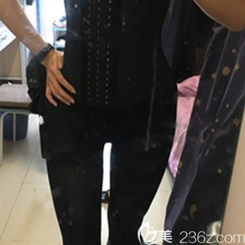 我找贛州薇琳鐘林輝做腰腹環(huán)吸術(shù)后第10天 我找贛州薇琳鐘林輝做腰腹環(huán)吸術(shù)后第10天