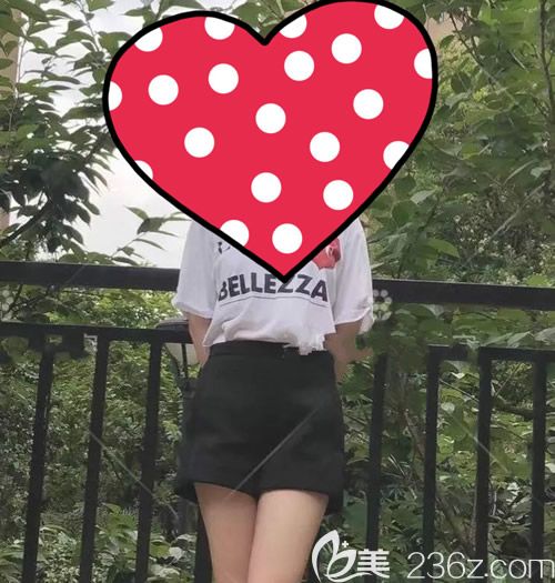 我找贛州薇琳鐘林輝做腰腹環(huán)吸術(shù)后60天效果 我找贛州薇琳鐘林輝做腰腹環(huán)吸術(shù)后60天效果