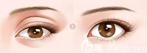 眼窩凹陷填充手術(shù)對(duì)比圖 眼窩凹陷填充手術(shù)對(duì)比圖