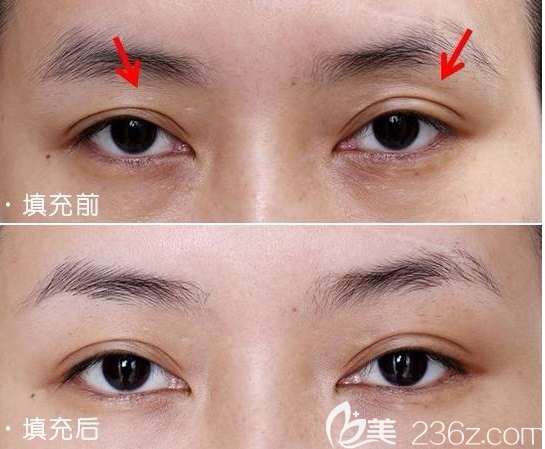 眼窩凹陷填充手術(shù)案例效果圖 眼窩凹陷填充手術(shù)案例效果圖