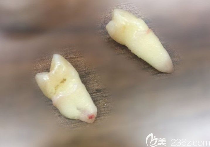 牙齒擁擠不齊矯正前拔掉2顆牙齒