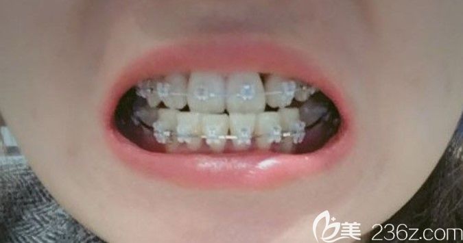 在看了口腔的價(jià)格表后，牙齒擁擠不齊的我在這里做了半隱形陶瓷矯正