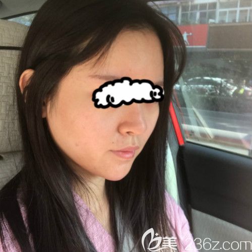 在贛州薇琳醫(yī)療美容成功做了隆鼻失敗修復(fù)手術(shù)第15天 在贛州薇琳醫(yī)療美容成功做了隆鼻失敗修復(fù)手術(shù)第15天