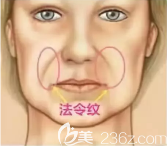 法令紋生長部位