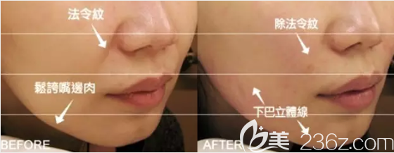 玻尿酸去法令紋效果