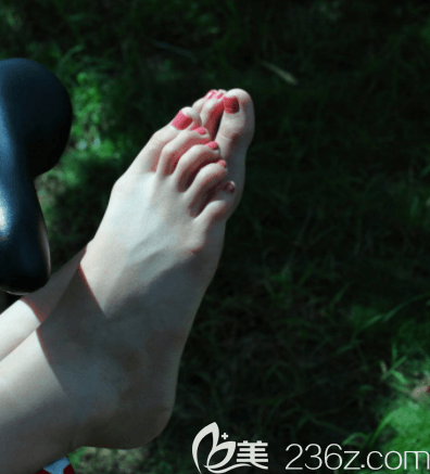 圣嘉新大腳骨好不好？我找蘇敬達(dá)做的大腳骨手術(shù)第61天