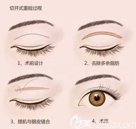 全切雙眼皮手術(shù)過程
