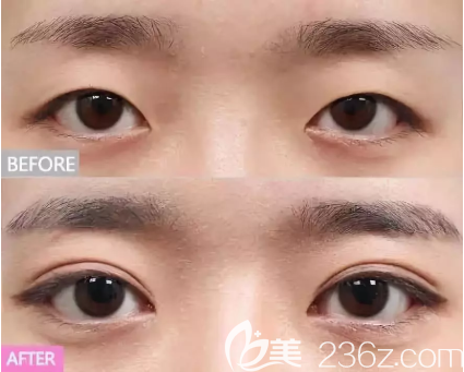 單眼皮變雙眼皮